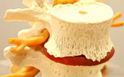 Degenerative Disc Disease and Back Pain