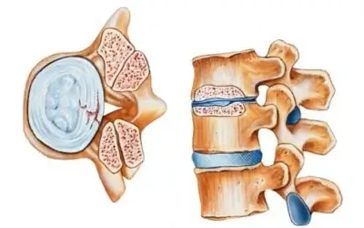 What Causes Spinal Stenosis and How Can I Treat It?