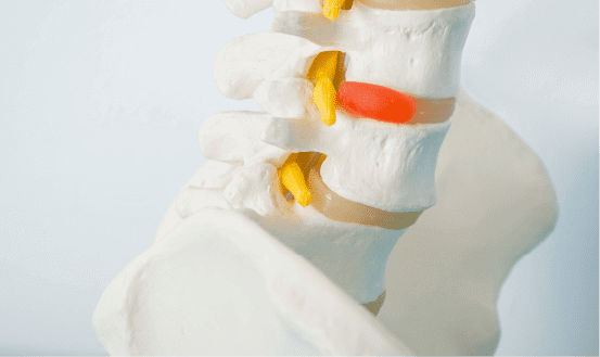 Herniated Disk