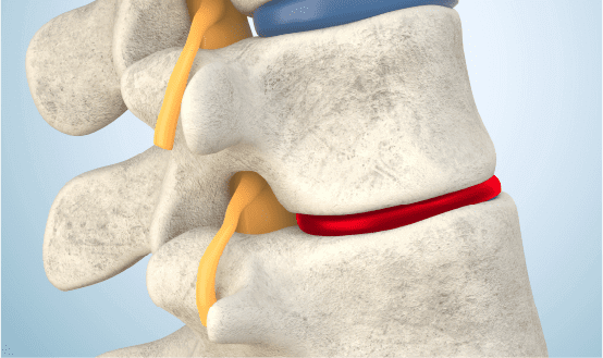 Degenerative Disk Disease