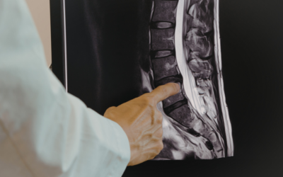 What Is the DRX9000 and Why Is It Canada’s Gold Standard for Spinal Decompression?