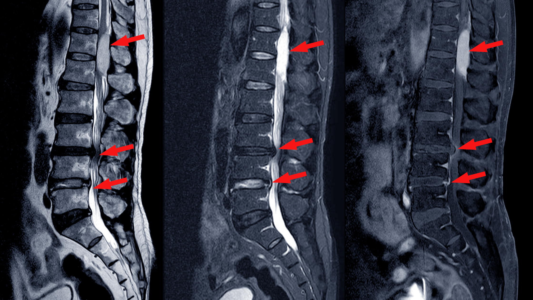 What Is a Bulging Disc vs. a Herniated Disc? Understanding the Difference