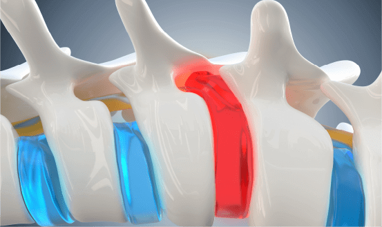 Illustration of a bulging and herniated spinal disc
