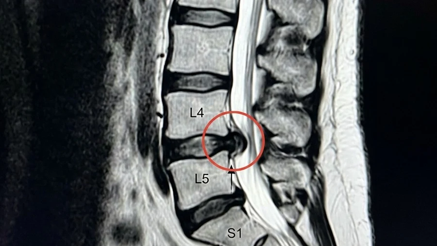 MRI showing a herniated disc between the L4 and L5 vertebrae